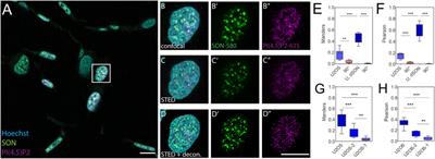 Quantitative super-resolution microscopy reveals the differences in the nanoscale distribution of nuclear phosphatidylinositol 4,5-bisphosphate in human healthy skin and skin warts